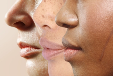 Dermapen 4 microneedling i Växjö hos Wasa Kliniken