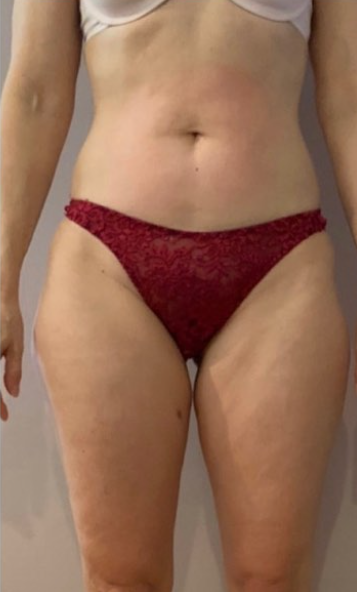 Endospheres efter behandling celluliter lår resultat