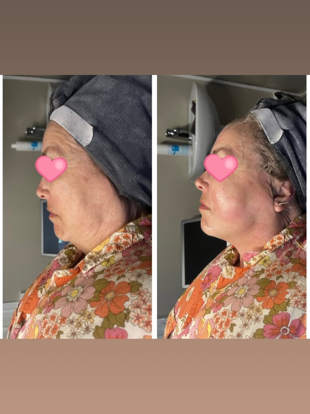 Före och efter 7D HIFU ansikte käklinje haka hals